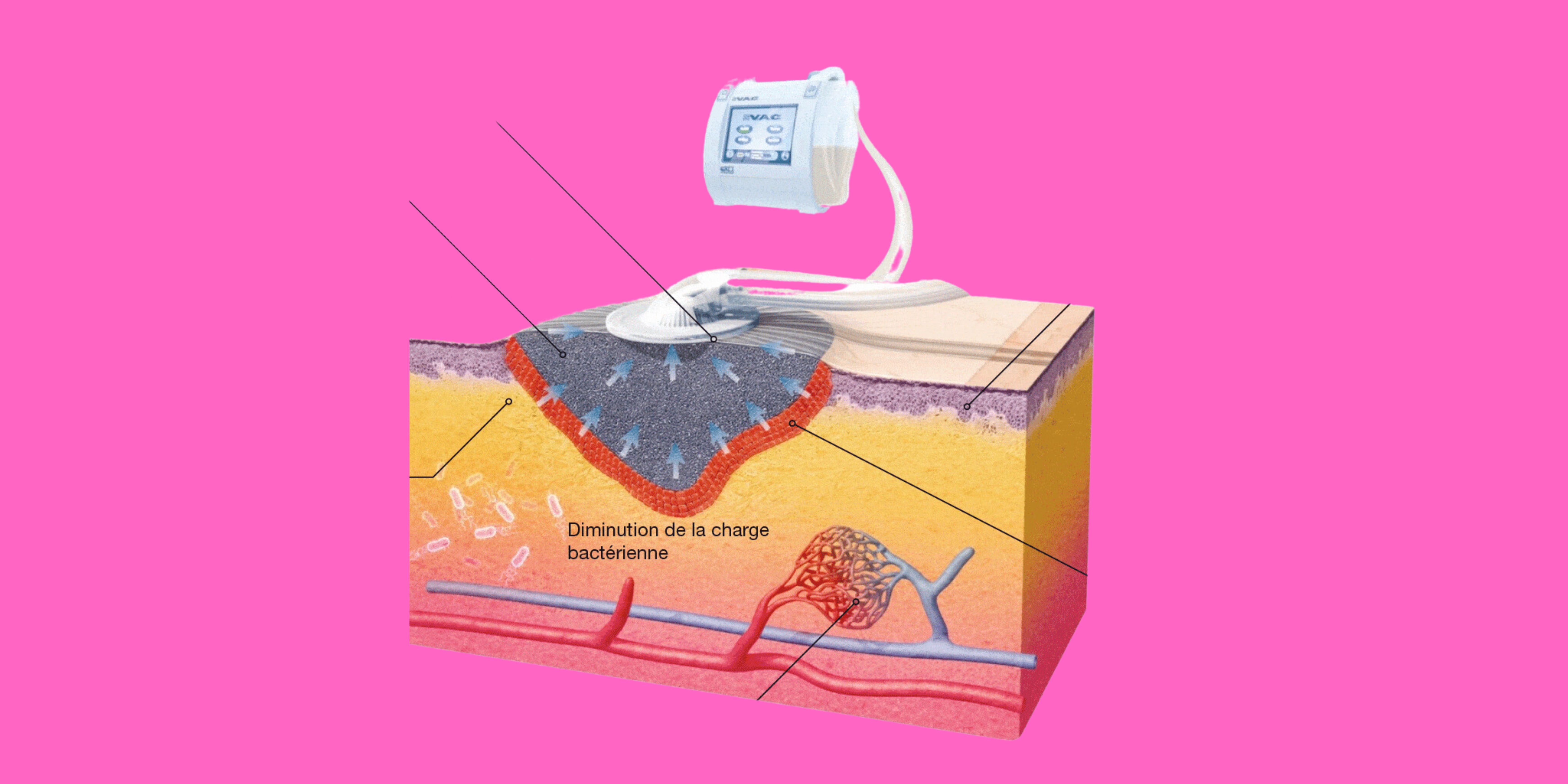 Comprendre le fonctionnement de la TPN