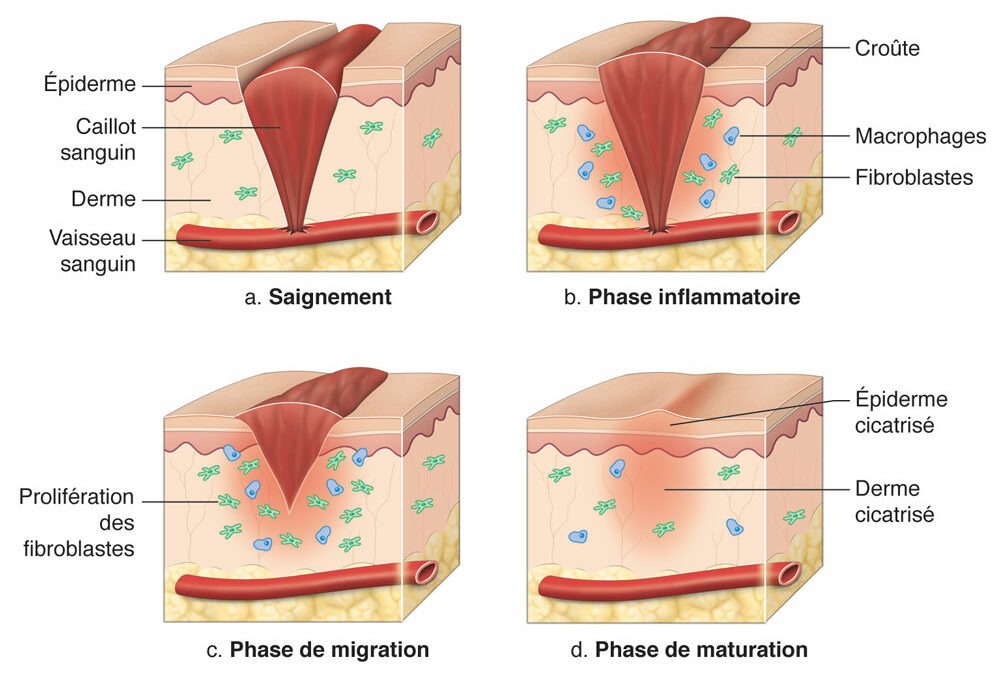 Les 4 phases de cicatrisation d’une plaie