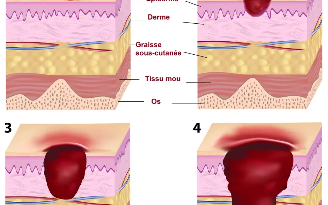 Les différents stades de l’escarre